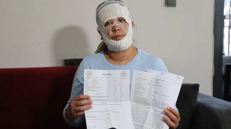 Adana'da güzellik merkezi faciası : Kadının yüzünde yanıklar oluştu