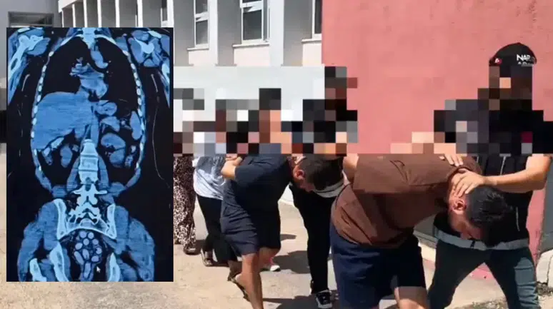 Adana'da midelerinden 1,5 kilo uyuşturucu çıktı