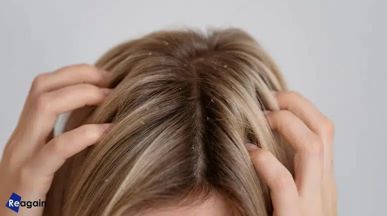 Saç deriniz sağlığınızla ilgili hangi sinyalleri veriyor? Saç derisinde görülen belirtiler ve anlamları