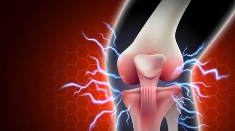 Bu rahatsızlığı hafife almayın! Dizde sıvı kaybı ve kireçlemeye karşı etkili çözüm